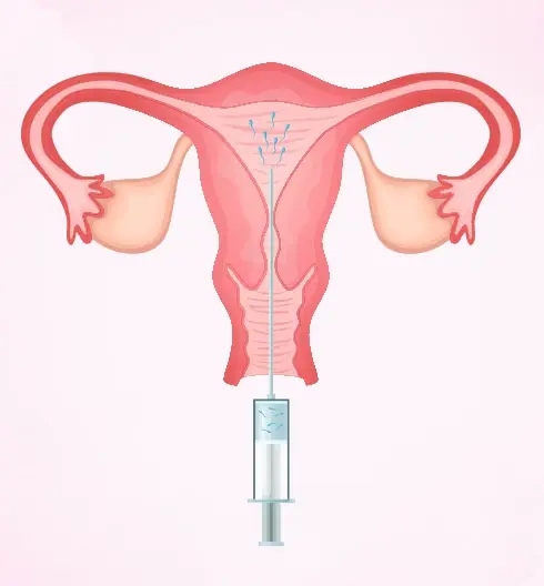 IUI
